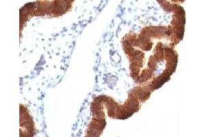 Formalin-fixed, paraffin-embedded human ovarian carcinoma stained with Cytokeratin 19 antibody (KRT19/799 + KRT19/800) (Cytokeratin 19 anticorps)