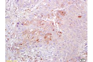 Formalin-fixed and paraffin embedded human lung carcinoma labeled with Anti Integrin alpha 3 Polyclonal Antibody , Unconjugated at 1:200, followed by conjugation to the secondary antibody and DAB staining (ITGA3 anticorps  (AA 976-1025))