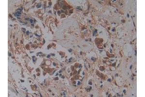 DAB staining on IHC-P; Samples: Human Breast cancer Tissue (GMFG anticorps  (AA 6-126))