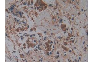 DAB staining on IHC-P; Samples: Human Breast cancer Tissue