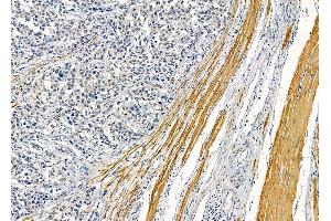 ABIN6263078 and ABIN6278934 at 1/100 staining human prostate cancer by IHC-P. (MAGEF1 anticorps  (Internal Region))