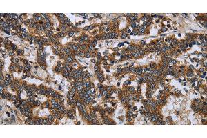 Immunohistochemistry of paraffin-embedded Human liver cancer tissue using LGALS2 Polyclonal Antibody at dilution 1:30 (Galectin 2 anticorps)