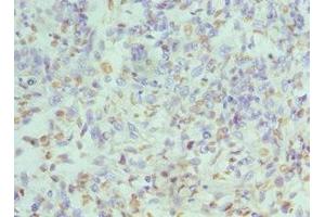 Immunohistochemistry of paraffin-embedded human endometrial cancer using ABIN7155102 at dilution of 1:100 (HNRNPD/AUF1 anticorps  (AA 1-306))