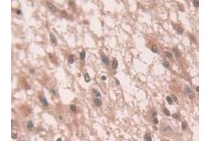 Detection of NOX1 in Human Glioma Tissue using Polyclonal Antibody to Nicotinamide Adenine Dinucleotide Phosphate Oxidase 1 (NOX1) (NOX1 anticorps  (AA 235-488))