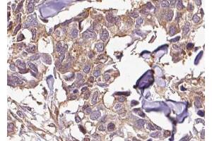ABIN6267656 at 1/100 staining human breast carcinoma tissue sections by IHC-P.