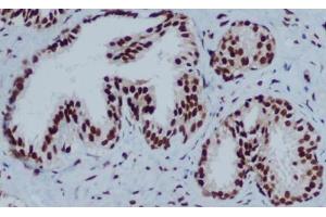 Immunohistochemical analysis of paraffin-embedded Prostate Cancer using HP1-gamma mouse mAb (1/200 dilution). (CBX3 anticorps)