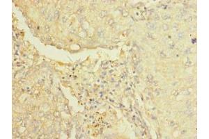 Immunohistochemistry of paraffin-embedded human lung cancer using ABIN7143633 at dilution of 1:100 (AARSD1 anticorps  (AA 1-230))