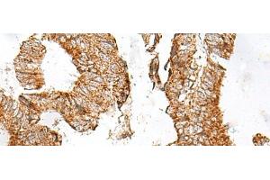 Immunohistochemistry of paraffin-embedded Human colorectal cancer tissue using GPR119 Polyclonal Antibody at dilution of 1:45(x200)
