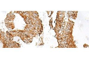 Immunohistochemistry of paraffin-embedded Human colorectal cancer tissue using GPR119 Polyclonal Antibody at dilution of 1:45(x200) (G Protein-Coupled Receptor 119 anticorps)