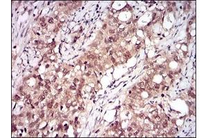 Immunohistochemical analysis of paraffin-embedded human cervical cancer tissues using RELB mouse mAb with DAB staining.