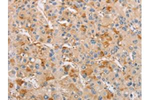 The image on the left is immunohistochemistry of paraffin-embedded Human liver cancer tissue using ABIN7128532(ARSF Antibody) at dilution 1/20, on the right is treated with fusion protein. (ARSF anticorps)
