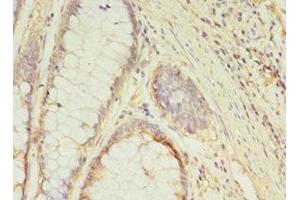 Immunohistochemistry of paraffin-embedded human colon cancer using ABIN7154452 at dilution of 1:100