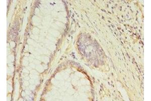 Immunohistochemistry of paraffin-embedded human colon cancer using ABIN7154452 at dilution of 1:100 (GCC1 anticorps  (AA 4-775))