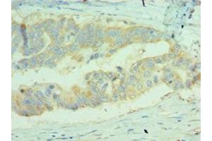 Immunohistochemistry of paraffin-embedded human colon cancer using ABIN7159680 at dilution of 1:100 (MICA anticorps  (AA 24-307))