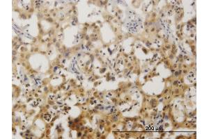 Immunoperoxidase of monoclonal antibody to ZNF496 on formalin-fixed paraffin-embedded human cholangiocarcinoma.