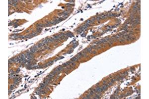 The image on the left is immunohistochemistry of paraffin-embedded Human colon cancer tissue using ABIN7190865(GREB1 Antibody) at dilution 1/40, on the right is treated with synthetic peptide. (GREB1 anticorps)