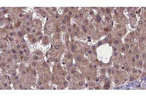 ABIN6277461 at 1/100 staining Human liver cancer tissue by IHC-P. (SSTR2 anticorps  (C-Term))