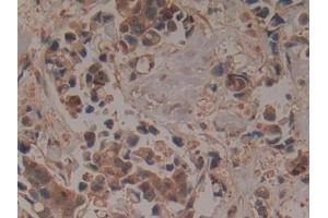 Detection of GCLM in Human Breast cancer Tissue using Polyclonal Antibody to Glutamate Cysteine Ligase, Modifier Subunit (GCLM) (GCLM anticorps  (AA 40-251))