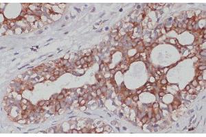 Immunohistochemistry of paraffin-embedded Human mammary cancer using TPD52 Polyclonal Antibody at dilution of 1:100 (40x lens). (TPD52 anticorps)