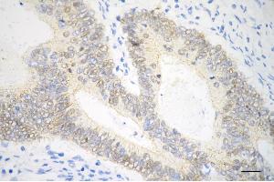Immunohistochemistry was performed on paraffin-embedded human sigmoid colon carcinoma using catenin beta 1 antibody (ABIN7797936), 1:200).