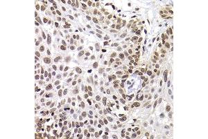 Immunofluorescence analysis of MCF7 cell using PHIP antibody. (PHIP anticorps)