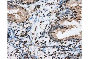 Immunohistochemical staining of paraffin-embedded Adenocarcinoma of ovary tissue N93ing anti-BSG mouse monoclonal antibody. (CD147 anticorps)