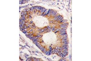 Formalin-fixed and paraffin-embedded human colon carcinoma tissue reacted with FXN antibody , which was peroxidase-conjugated to the secondary antibody, followed by DAB staining.