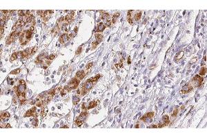 ABIN6278051 at 1/100 staining Human liver cancer tissue by IHC-P. (Angiotensin II Type 2 Receptor anticorps)