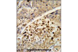 Formalin-fixed and paraffin-embedded human hepatocarcinoma reacted with NR1I2 Antibody , which was peroxidase-conjugated to the secondary antibody, followed by DAB staining. (NR1I2 anticorps  (AA 100-127))