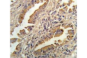 IHC analysis of FFPE human lung carcinoma stained with IL-8 antibody (IL-8 anticorps  (AA 72-99))