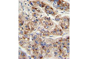 Formalin-fixed and paraffin-embedded human hepatocarcinoma with EHHADH Antibody , which was peroxidase-conjugated to the secondary antibody, followed by DAB staining. (EHHADH anticorps  (C-Term))