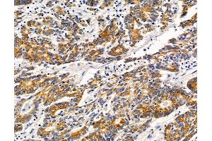 ABIN7095825 and ABIN7099887 at 1/100 staining human colorectal cancer by IHC-P.