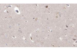 ABIN6273038 at 1/100 staining Human brain cancer tissue by IHC-P.