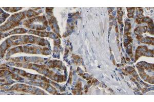 ABIN6267164 at 1/100 staining Human thyroid cancer tissue by IHC-P. (DLG4 anticorps  (pSer295))