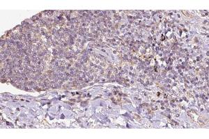 ABIN6273151 at 1/100 staining Human lymph cancer tissue by IHC-P. (Peroxiredoxin 5 anticorps  (C-Term))