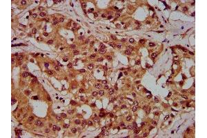 IHC image of ABIN7162774 diluted at 1:300 and staining in paraffin-embedded human liver cancer performed on a Leica BondTM system.