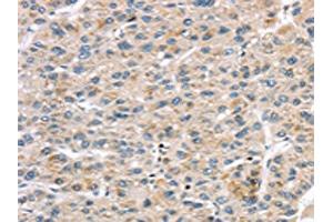The image on the left is immunohistochemistry of paraffin-embedded Human liver cancer tissue using ABIN7191331(LZTS1 Antibody) at dilution 1/20, on the right is treated with synthetic peptide. (LZTS1 anticorps)
