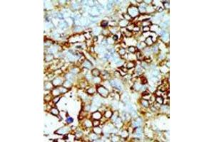 Formalin-fixed and paraffin-embedded human cancer tissue reacted with the primary antibody, which was peroxidase-conjugated to the secondary antibody, followed by AEC staining. (MAP4K2 anticorps  (Middle Region))