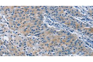 Immunohistochemistry of paraffin-embedded Human gastric cancer tissue using BMPR1B Polyclonal Antibody at dilution 1:30 (BMPR1B anticorps)