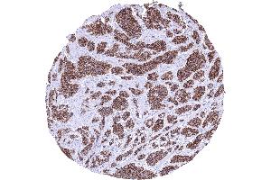 Ileum Neuroendocrine tumor with strong CDH17 immunostaining of all tumor cells CDH17 immunohistochemistry (LI Cadherin anticorps  (AA 242-418))