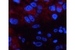 Immunofluorescence analysis of Human liver cancer tissue using CST3 Monoclonal Antibody at dilution of 1:200. (CST3 anticorps)