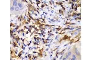 Immunohistochemistry of paraffin-embedded Human liver cancer using HCLS1 Polyclonal Antibody at dilution of 1:100 (40x lens). (HCLS1 anticorps)