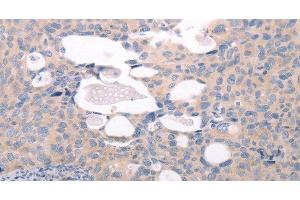 Immunohistochemistry of paraffin-embedded Human cervical cancer tissue using ABCF1 Polyclonal Antibody at dilution 1:40 (ABCF1 anticorps)