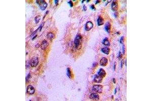 Immunohistochemical analysis of Recoverin staining in human lung cancer formalin fixed paraffin embedded tissue section.