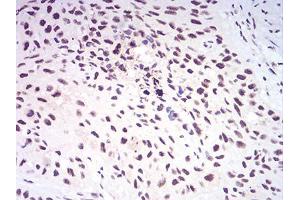Immunohistochemical analysis of paraffin-embedded esophageal cancer tissues using KDM1A mouse mAb with DAB staining.