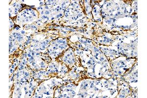 ABIN6265163 and ABIN6272472 at 1/100 staining Human lung cancer by IHC-P. (Transgelin anticorps  (C-Term))