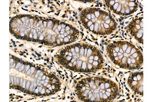ABIN6256914 and ABIN6274189 at 1/100 staining Human colorectal cancer and adjacent normal tissues by IHC-P. (ATF3 anticorps  (C-Term))