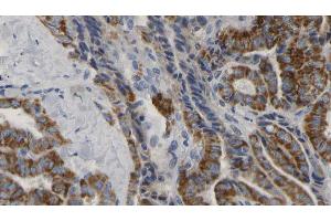ABIN6267176 at 1/100 staining Human thyroid cancer tissue by IHC-P. (INPP5D anticorps  (pTyr1020))