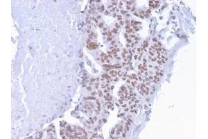 Formalin-fixed, paraffin-embedded human Breast Carcinoma stained with CHD4 Mouse Monoclonal Antibody (3F2/4). (CHD4 anticorps  (C-Term))