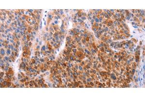 Immunohistochemistry of paraffin-embedded Human liver cancer using AADAC Polyclonal Antibody at dilution of 1:30 (AADAC anticorps)